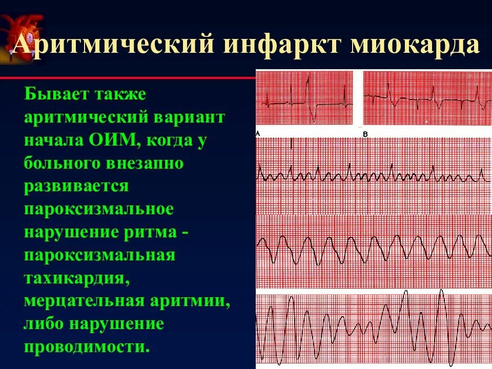 Варианты острого инфаркта миокарда