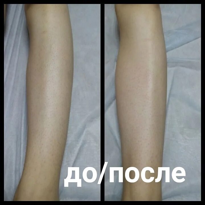 Депиляция барнаул. Лулу студия лазерная эпиляция. Таня шугар. Лазерная эпиляция во владимире. Подготовка до депиляции.