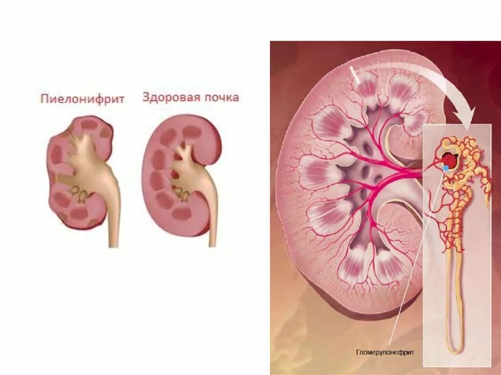 Заболевание почек гломерулонефрит. Болезни почек пиелонефрит гломерулонефрит. Острый левосторонний пиелонефрит. Почка пораженная гломерулонефритом. Почечные заболевания у детей.
