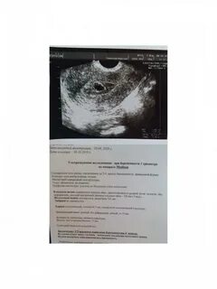 3 неделя беременности от зачатия узи