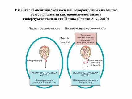 Резус болезнь
