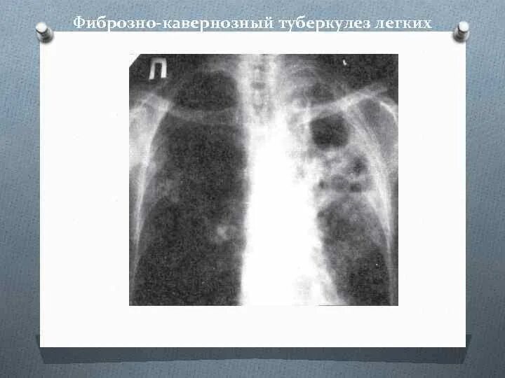 Кавернозный туберкулез рентген. Кавернозный туберкулез каверна. Фиброзно-кавернозный туберкулез рентген. Фиброзная каверна это туберкулезе.
