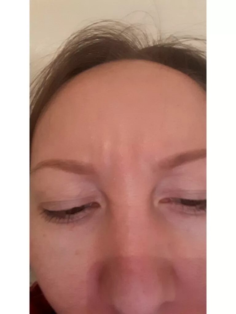 Коричневая полоса на лбу. Глубокая морщина на переносице. Складка морщина на переносице. Глубокая морщина на переносице. Межбровная морщина.