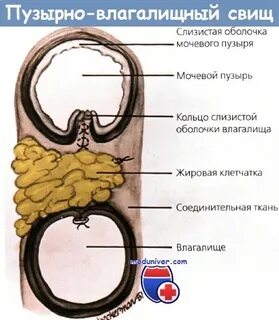 Влагалищный свищ