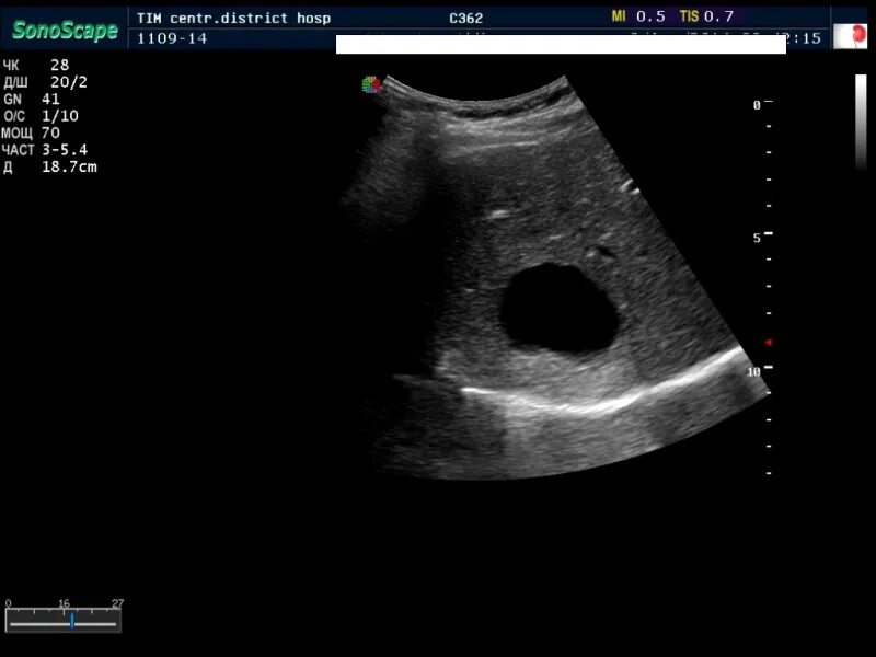 Киста на печени можно. Сонограмма киста печени. Солитарные кисты печени УЗИ. Солитарная киста печени. Простая солитарная киста печени.