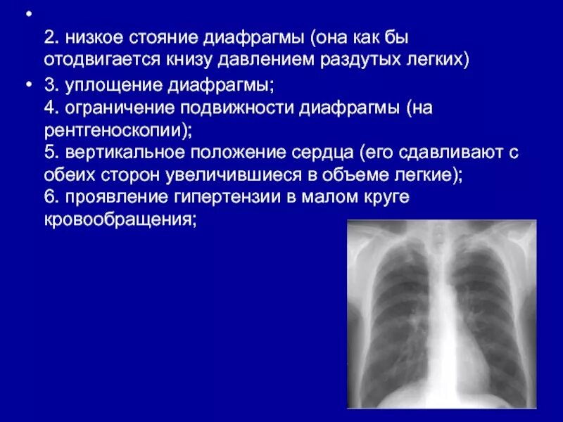 Причины диафрагмы. Низкое стояние диафрагмы. высокое стояние диафрагмы. низкое стояние купола диафрагмы. уплощенный купол диафрагмы.