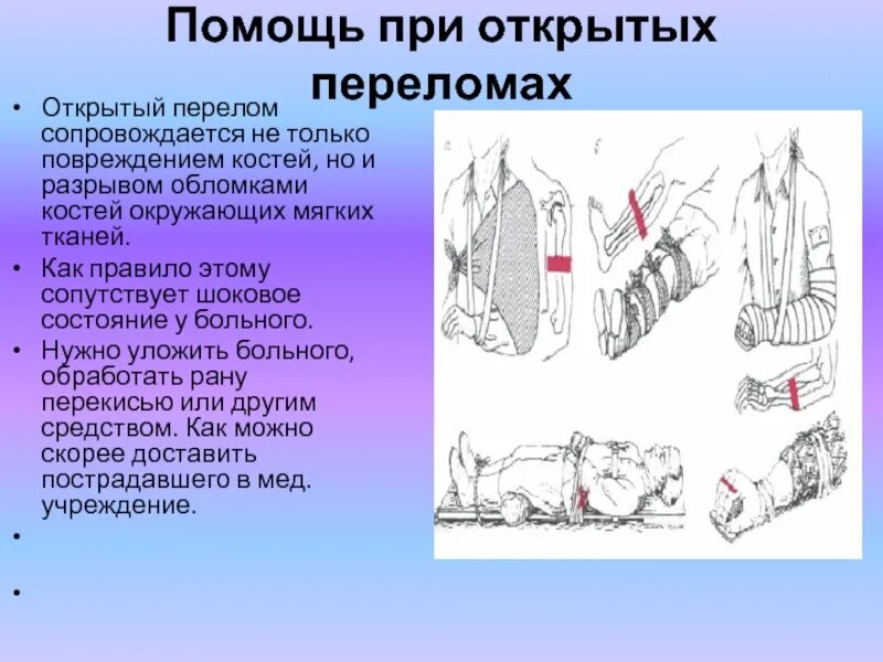 Действия проводника при открытых переломах. Помощь при открытом переломе. Травмы скелета и первая помощь. Повреждение при переломе. Открытый перелом первая помощь.