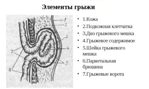Грыжа как правильно называется