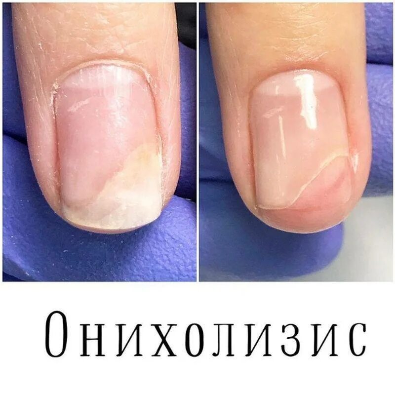 Что делать после снятия ногтя. Гиперкератотический онихолизис. Микроспория онихолизис.