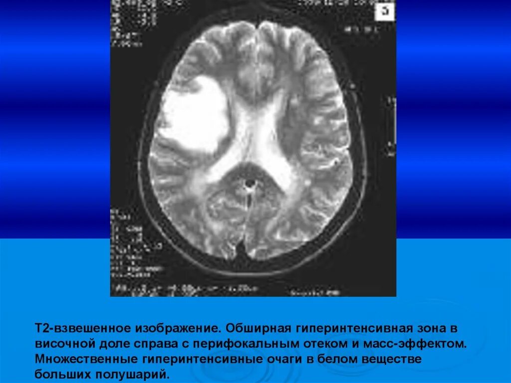 Без перифокальной реакции. Перифокальный отек мозга на кт. Перифокальный отек головного мозга мрт. Перифокальный отек вещества мозга что это.