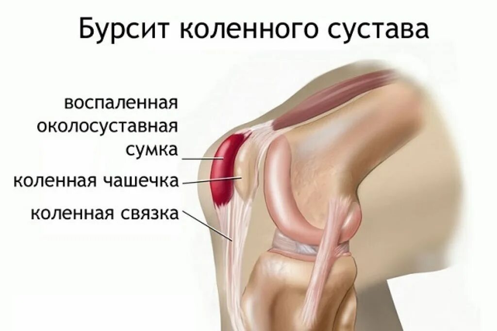 Инфрапателлярный бурсит. Супрапателлярный синовит (супрапателлярный бурсит). Супрапателлярный бурсит коленного сустава на кт. Супрапателлярный бурсит рентген.