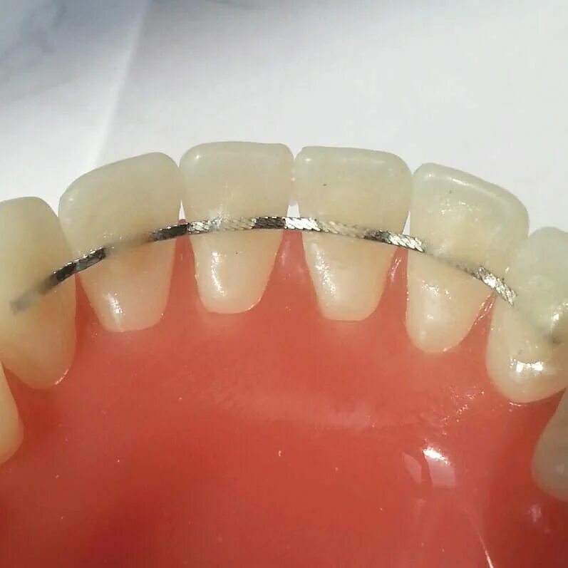 ретейнер каппа ортодонтический. дуга на зубы после брекетов. ретенционная каппа несъемная. дуга на зубы после брекетов. дуга на зубы после брекетов.