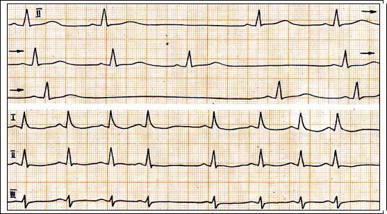 Са блокада 2 тип. Ритм синоатриальная блокада. Синоатриальная блокада 2 степени 1 типа. Предсердно-желудочковая блокада 2 степени. Синоатриальная блокада 2 степени с периодикой Венкебаха.