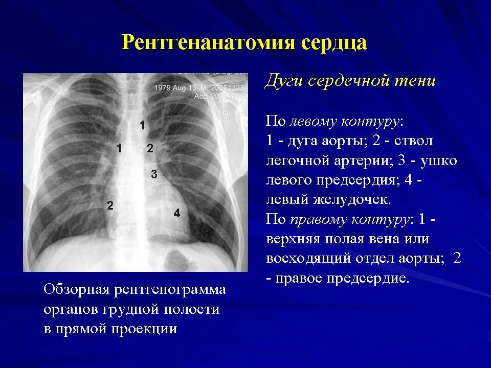 Округлыми формами в легком. Легочный ствол на рентгенограмме. Дуги сердца на рентгене ОГК. Нормальная рентгенограмма сердца. Тень сердца на рентгенограмме в норме.