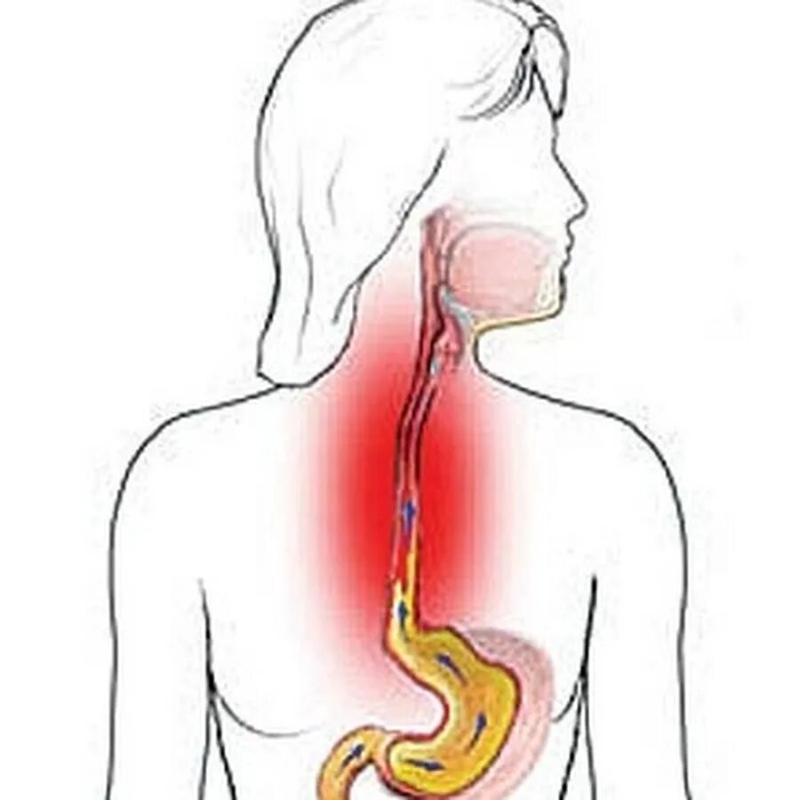 Жжение в пищеводе после