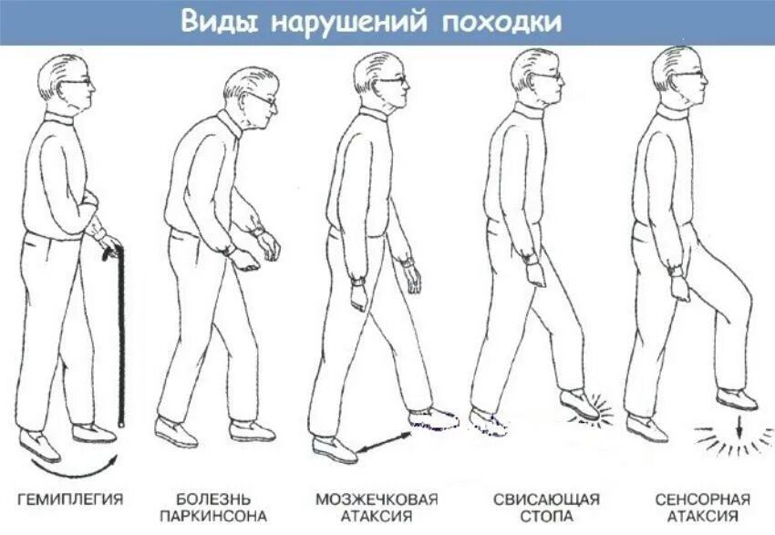 Типы походок. Типы походок неврология. Типы нарушения походки. Виды походок. Нарушение походки неврология.