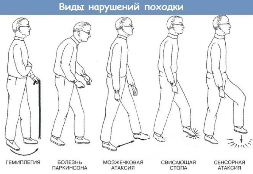 Почему стоя становится плохо. Типы походок неврология. Виды нарушения походки. Типы походок. Нарушение походки неврология.