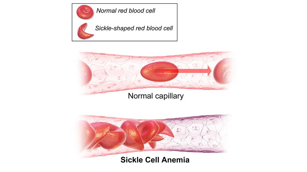 Серповидноклеточная анемия проявления. Патогенез серповидно клеточной анемии. Серповидноклеточная анемия механизм развития. Серповидноклеточная анемия замещение. Серповидно клеточная анемия признаки