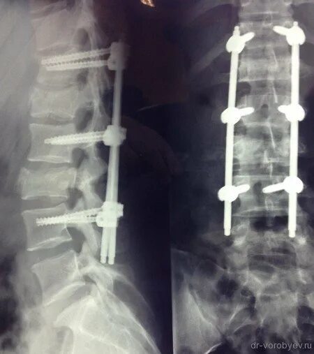 Транспедикулярная стабилизация позвоночника. Транспедикулярный остеосинтез. Перелом позвоночника остеосинтез рентген. Реабилитация после операции на позвоночнике с металлоконструкций