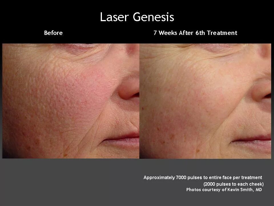 Ipl лазер для лица отзывы. фотоомоложение отзывы пациентов. удаление глубоких сосудов на лице cutera. фотоомоложение на аппарате м22. фотовспышка m22 омоложение.