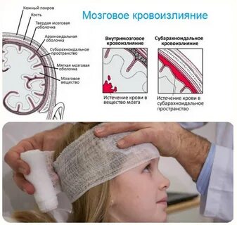 Отек головного мозга g 93.6