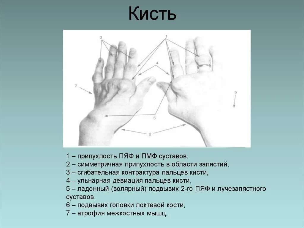 Разгибание кисти и пальцев. Отведение пальцев кисти. Свисающая кисть при поражении. Отведение пальцев кисти. Абдукция и аддукция в анатомии.
