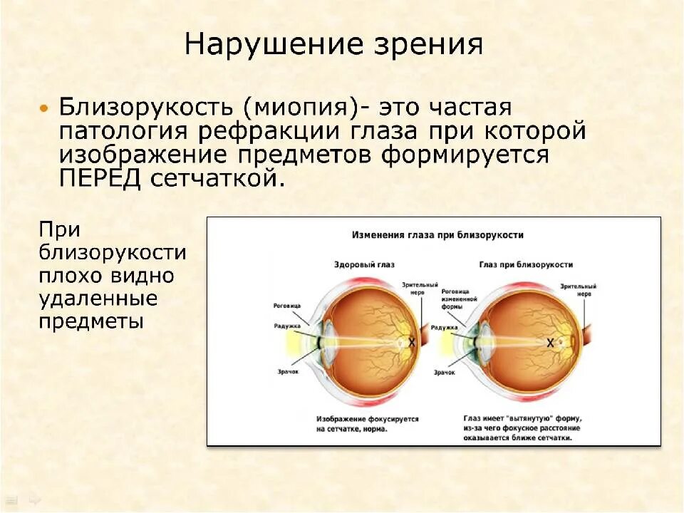 У близоруких людей изображение фокусируется перед сетчаткой. Где фокусируется изображение при близорукости. Хрусталик при близорукости. Близорукость фокус перед сетчаткой. Анализаторы биология.