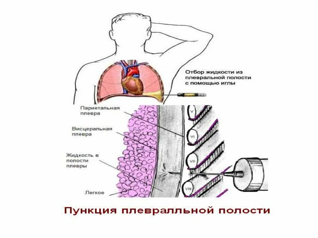 Лечение плевральной полости. Эмпиема плевры пункция. Эмпиема плевры плевральная жидкость. Дренирование эмпиемы плевры.