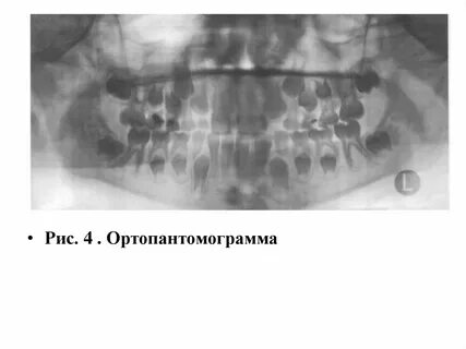 Зонография