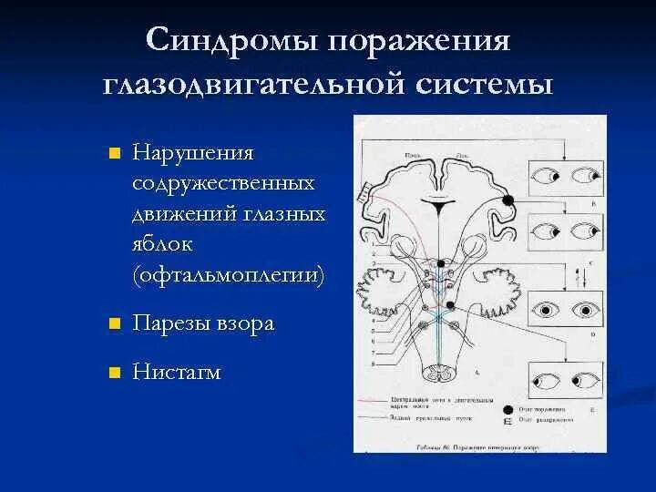 Поражение ствола головного. Синдром поражения мозгового ствола. Синдромы поражения глазодвигателей. Синдромы поражения ствола мозга. Нарушение содружественного движения глаз-это:.