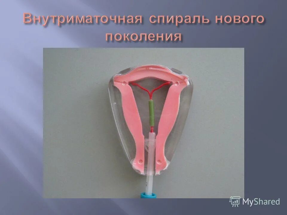 Как работает внутриматочная спираль. Спираль внутриматочная. внутриматочные контрацептивы. спираль женская. кольцевая спираль внутриматочная.