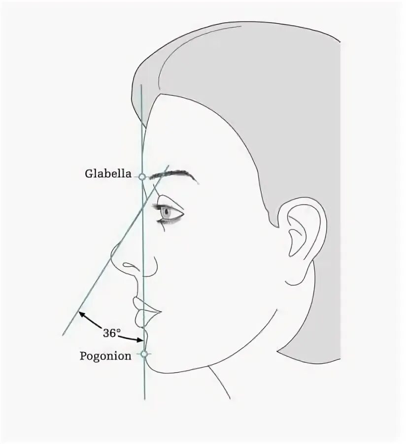 Коррекция подбородка схема. Схема укола липолитиков на подбородок. Лицо в профиль рисунок. Схема лица для контурной пластики. Форма подбородка.