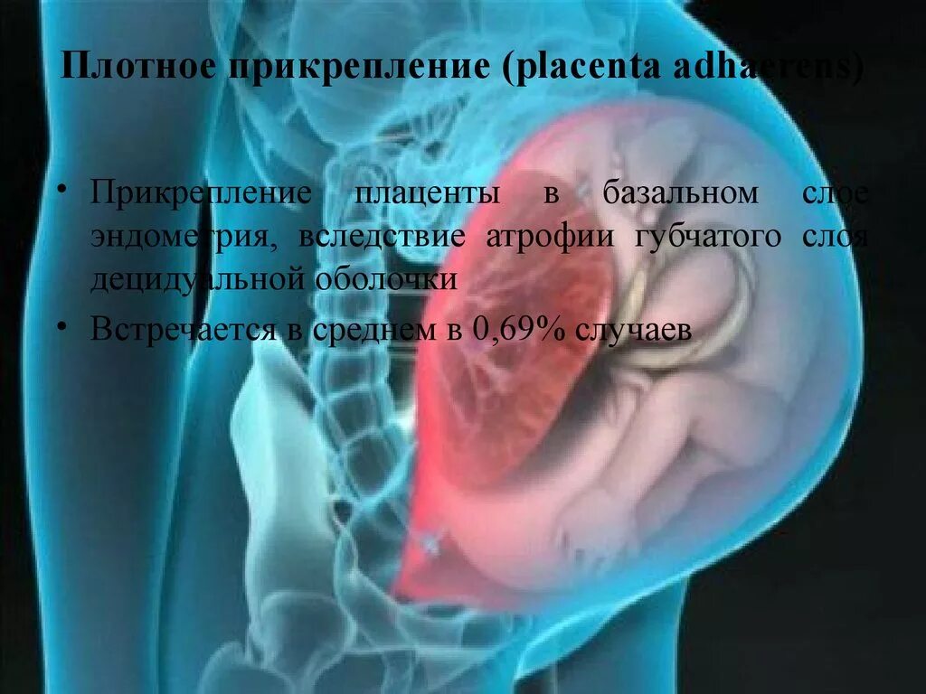 Плацента на рубце матки. Аномалии прикрепления последа.