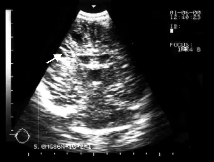 Субэпендимальная киста на УЗИ. Полость Верге у новорожденного на УЗИ. Ультразвуковая анатомия головного мозга плода.