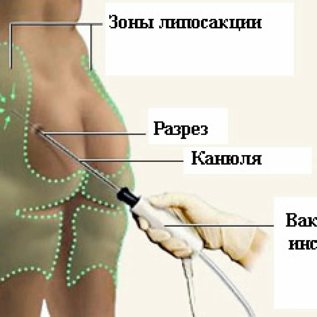 Зоны для криолиполиза. Зоны липосакции. Зоны липосакции. Проблемные зоны у женщин. Лазерная липосакция галифе.