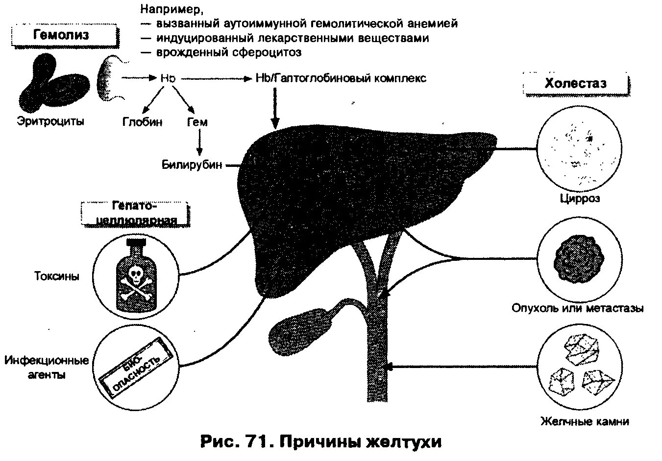 Печеночная желтуха билирубин. Печеночная желтуха патогенез схема. патогенез механической желтухи. механическая желтуха механизм развития. механизм образования механической желтухи.
