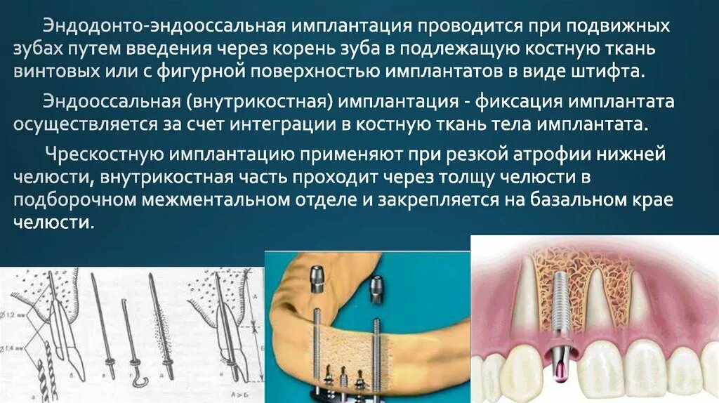 Как определить имплантацию