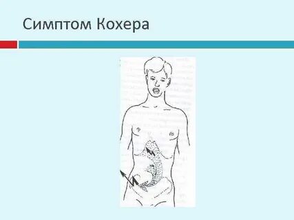 Симптом кохера при аппендиците