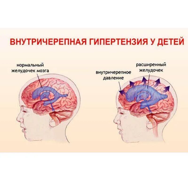 Сильное головное давление. Внутричерепная гипертензия симптомы. Повышение внутричерепного давления. Синдром внутричерепной гипертензии. Давление Черепного мозга.