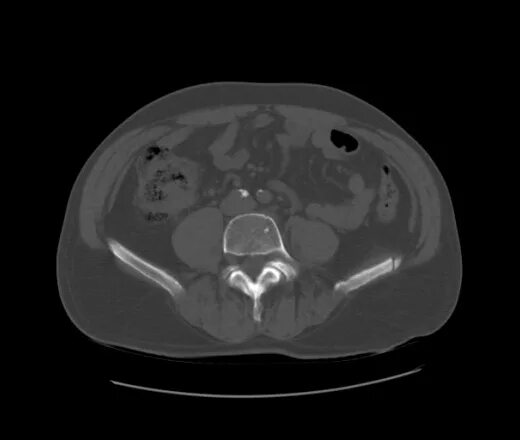 Кт подвздошной кости. Фиброзная дисплазия подвздошной кости на кт. Гемангиома подвздошной кости на кт. Гемангиома подвздошной кости мрт. Гемангиома костей таза на кт.