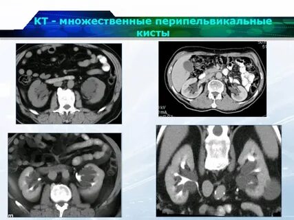 В почке обнаружили кисту