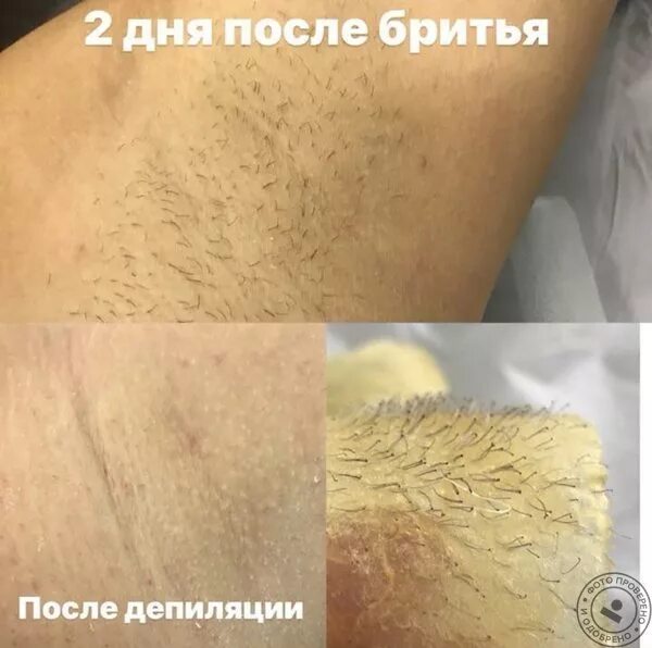 Какой длины должны быть волосы для шугаринга