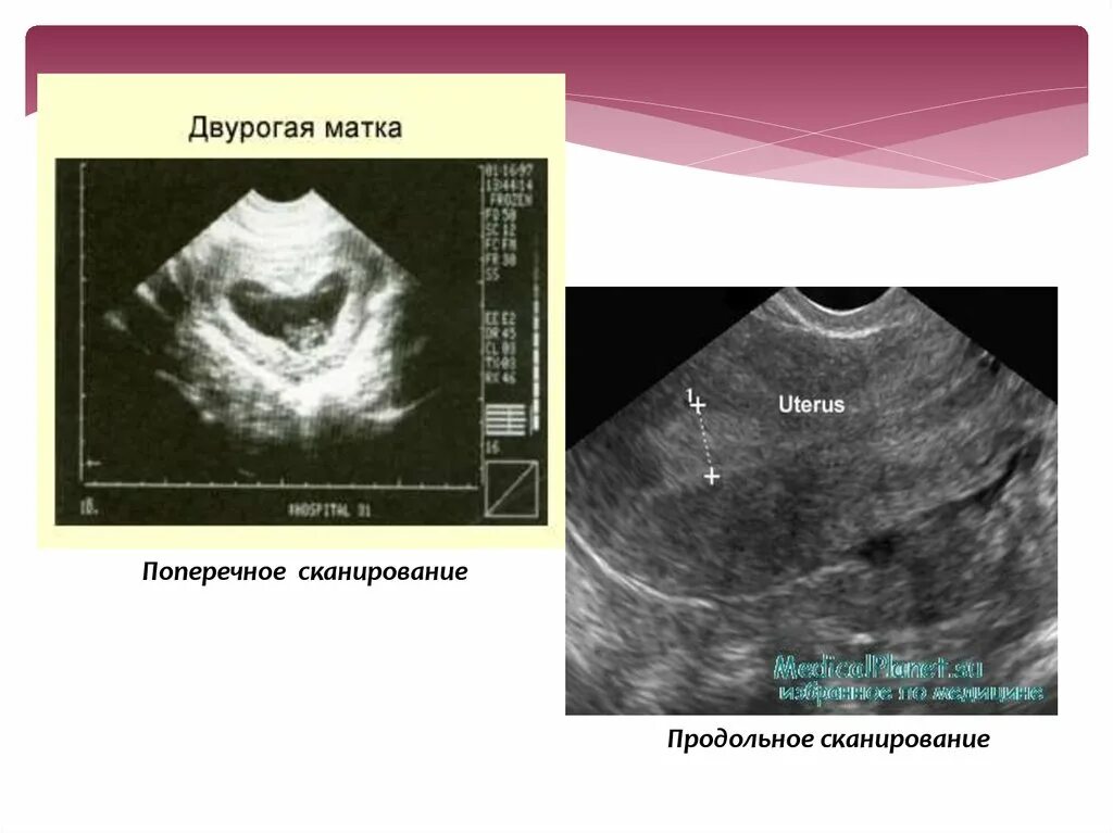 Двурогая матка на УЗИ. Продольное и поперечное сканирование в УЗИ. Аномалия матки двурогая. Двурогая матка и беременность. Что такое двурогая матка