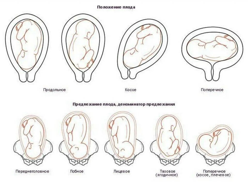 33 недели тазовое. Продольно головное предлежание плода. Головное предлежание плода поперечное положение. Головное предлежание плода 2 позиция. Положение предлежание вид и позиция плода.