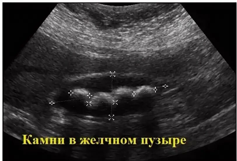 Узи. Ультразвуковое исследование брюшной полости. Заключение фгдс при дискинезии желчевыводящих путей. Джвп на узи брюшной полости. Джвп на узи брюшной полости.