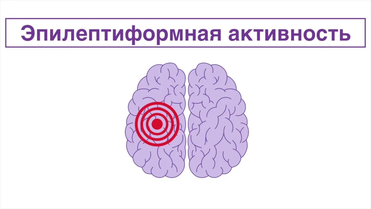 Что значит эпилептиформная активность. Эпилептиформная активность. Эпилептиформная активность на ЭЭГ. Интериктальная эпилептиформная активность. Эпилептиформный феномен.