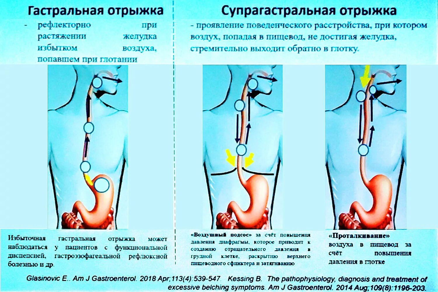 Воздух в желудке причины и лечение. Отрыжка механизм возникновения. Механизм появления отрыжки. Механизм развития отрыжки.