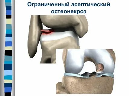 Остеонекроз
