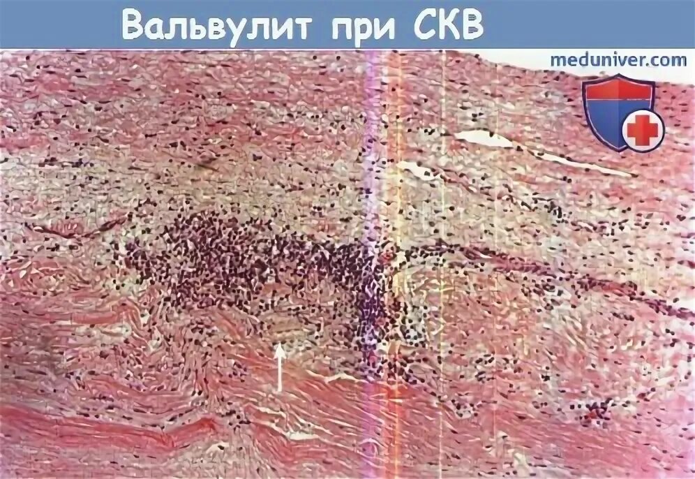 Вальвулит это. Ревматический вальвулит. интерстициальный вальвулит.