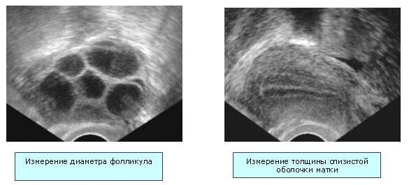 Трансвагинальная пункция яичников. Фолликулы в яичниках норма УЗИ. Фолликула стимулирующий
